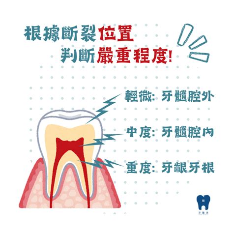 牙齒掉下來|門牙斷掉/脫落怎麼辦？3步驟拯救脫落的牙齒，1狀況。